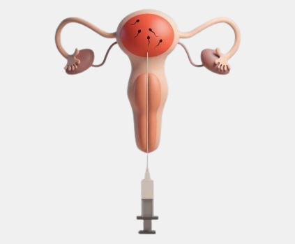 IUI Procedure