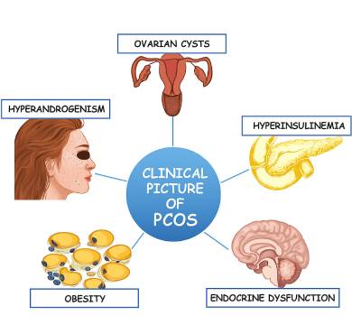 PCOS