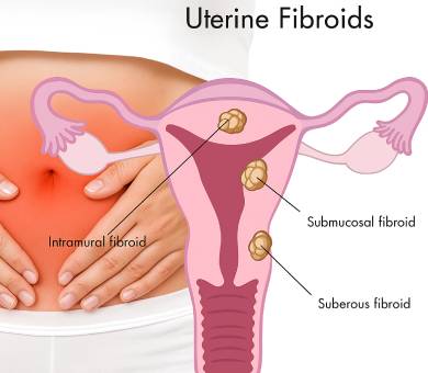 Uterine-Fibroids-fb