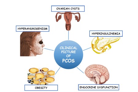 PCOS