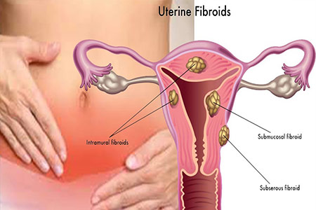 Uterine-Fibroids-fb