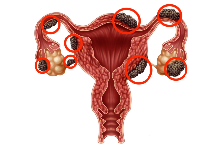 Endometriosis